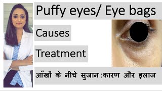 puffy eyes eye bags aankhon ke neeche sujan  कारण और इलाज  Dr Aanchal  dermatologist [upl. by Delanty]