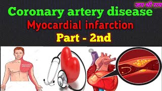 Myocardial infarction part2 [upl. by Haldis676]