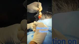 cyst removal in Tanvi Hospital Shimoga [upl. by Nolyak]