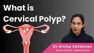 What is Cervical Polyp  Causes and Treatment  DrRicha Vaishnav [upl. by Oguh]