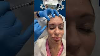 Botox touch up in West Palm Beach Gardens  Best Glabellar lines Forehead lines Crows Feet Botox [upl. by Joanne]