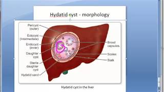 Pathology 617 a hydatid cyst morphology pericyst liver capsule sand fluid echinococcus [upl. by Kelwunn]