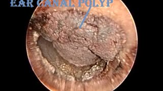 Dried Hemorrhagic Ear Canal Polyp Removal amp Cleaning [upl. by Pero]