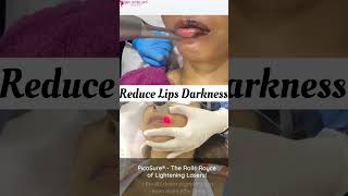 Dark Lip Correction with Laser Lip lightening treatment is a safe method that can lighten the tone [upl. by Ragouzis]