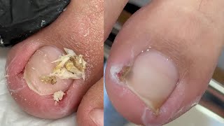 Treatment for Ingrown Toenails 008 satisfying nailsAlphanalis HCM [upl. by Leddy]