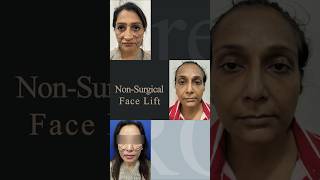 𓍼 Nonsurgical Infinite Thread Facelift Workshop Immediate Painless Results Lasting 10 Years [upl. by Naihtniroc]