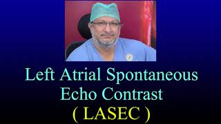 Left Atrial Spontaneous Echo Contrast  L A S E C  In Severe Mitral Stenosis amp Atrial Fibrillation [upl. by Ozne722]