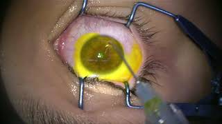 Corneal Collagen Cross Linking for Keratoconus [upl. by Bravin780]