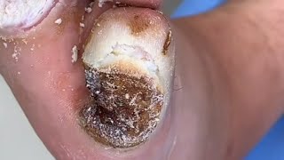 plantar warts resolved after eight treatments and clearancePedicure video 43vertical plantaris feet [upl. by Lekcim]