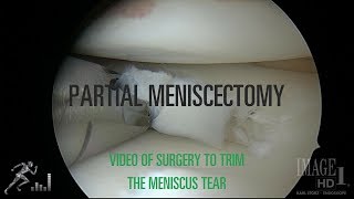 Partial meniscectomy Video of this meniscus surgery [upl. by Ailadi368]