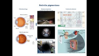 Retinitis pigmentosa pathophysiology and treatment advances [upl. by Rocray]