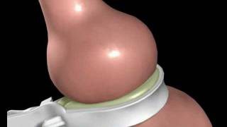 Lap Band Surgery  Laparoscopic Gastric Banding  Animation [upl. by Annayoj289]