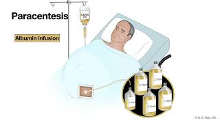 LiverCirrhosisAscites5cTherapyLarge Volume Paracentesis [upl. by Ellis]