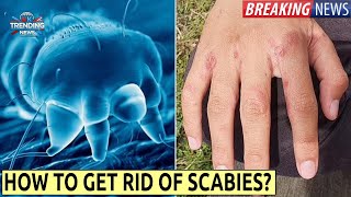 Scabies outbreak UK  Symptoms and how to get rid of [upl. by Fair572]