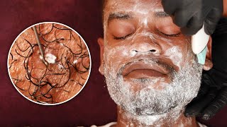 BEST SKINCARE TREATMENT WITH SATISFYING INGROWN HAIR REMOVAL  Beard Mask Facial [upl. by Dona]