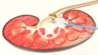 UROMED Balloon Catheter Set NEPHROquick®  Percutaneous nephrostomy catheter for renal drainage [upl. by Peppel]