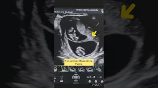 “Key Ultrasound Findings in Dichorionic Diamniotic Twins” [upl. by Hermon]