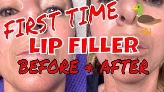 FIRST TIME LIP FILLER BEFORE AND AFTER JUVEDERM [upl. by Llekcm]