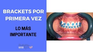 BRACKETS POR PRIMERA VEZ  Lo que debes saber de Ortodoncia [upl. by Lika]