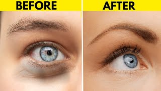 10 Easy Home Remedies To Get Rid Of Eye Bags  Get Rid Of Dark Circles [upl. by Neelav]