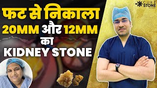 No SCAR amp NO PAIN  फट से निकाला 20 mm amp 12mm Kidney Stones  Laser Removal of 20mm amp12mm Stones [upl. by Applegate]