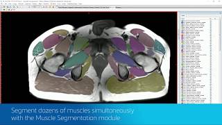 Medical Image Segmentation Made More Intuitive  Mimics Innovation Suite 200 [upl. by Leachim948]