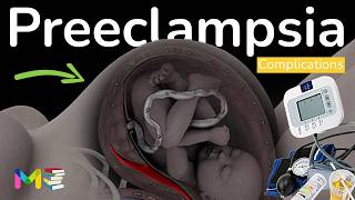 7 COMPLICATIONS OF PREECLAMPSIA Hypertension in pregnancy [upl. by Pavyer]