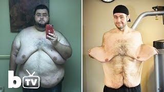 My 300lbs Weight Loss Left Me With 13lbs Of Loose Skin [upl. by Ayomat]