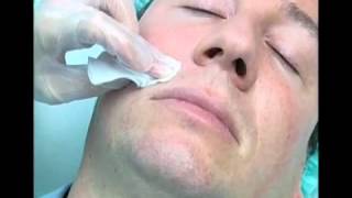 Surcos Nasogenianos  Tratamiento Facial [upl. by Blane]