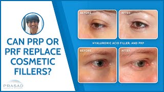 Why PRP or PRF Cannot Replace Dermal Fillers [upl. by Lower]