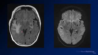 Imaging brain tumors  5  Non glial tumors [upl. by Sirovaj]