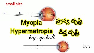 Myopia Hypermetropia corrections [upl. by Knipe]