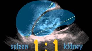 SonoKids Tutorials  ScanTip  SPLENOMEGALY [upl. by Inalan531]