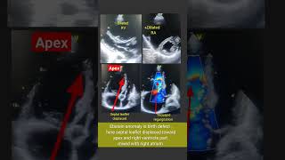 2D Echo of Ebstein anomaly l Tricuspid valve echotest shorts [upl. by Hendrik]