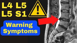 WARNING These Are The 3 MAJOR Symptoms of a Severe L4 L5 L5 S1 Disc Bulge  Dr Walter Salubro [upl. by Rozelle294]