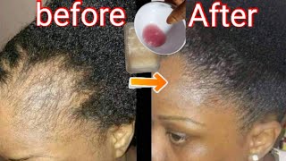 I used Rice Water on my Hair for 2 months After Haircut [upl. by Beverlee]