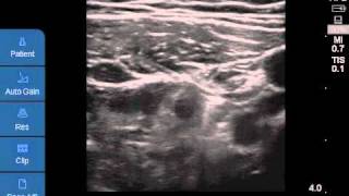 Ultrasoundguided CFNB [upl. by Ahsap]