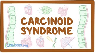 Carcinoid Syndrome  causes symptoms diagnosis treatment pathology [upl. by Randee]