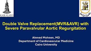 Double Valve Replacement with Severe Paravalvular Aortic Regurgitation Paravalvular Leak or PVL [upl. by Gross]