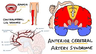 Anterior Cerebral Artery Stroke Syndrome  ACA Stroke Syndrome  Stroke Syndromes [upl. by Uball739]