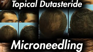 Microneedling and Topical Dutasteride [upl. by Gwenore]