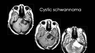 Radiology  Imaging of the Posterior Fossa amp its Lesions [upl. by Dnomaid]