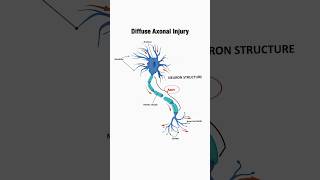 What is diffuse axonal injury relating to Traumatic Brain Injury [upl. by Toomin]