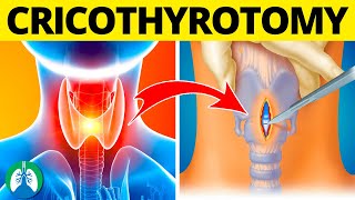 Cricothyrotomy Medical Definition  Quick Explainer Video [upl. by Macnamara89]