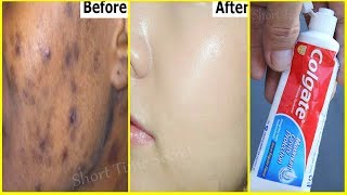 In 2 DAYSRemove DARK SPOTS With Toothpaste Apply Toothpaste on Your Darkspots and See the Magic [upl. by Esiuolyram]