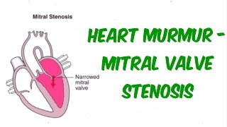 Mitral Stenosis  Auscultation Sound [upl. by Ellehciram]