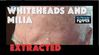 Whiteheads and milia extracted after Mohs surgery [upl. by Helbonnah]