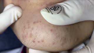 Acne On Girls Chin  Acne Treatment Nhat Bang [upl. by Ahsiekar]