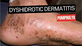 Dyshidrotic Eczema Pompholyx [upl. by Aligna368]