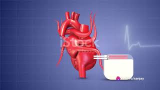 Pacemakers The Hearts Rhythm Keeper [upl. by Marquardt]